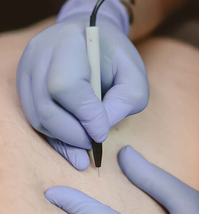 Thermolysis probe being used at Hideaway Spa Windsor