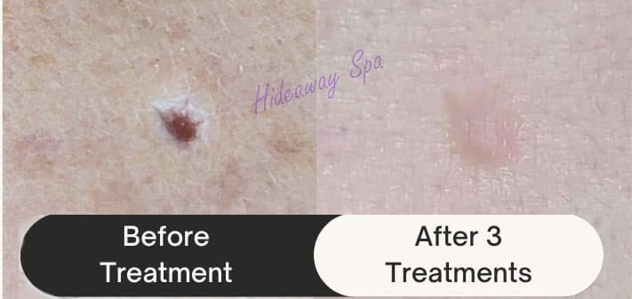 Before and after: deep cyst scar filled in Windsor