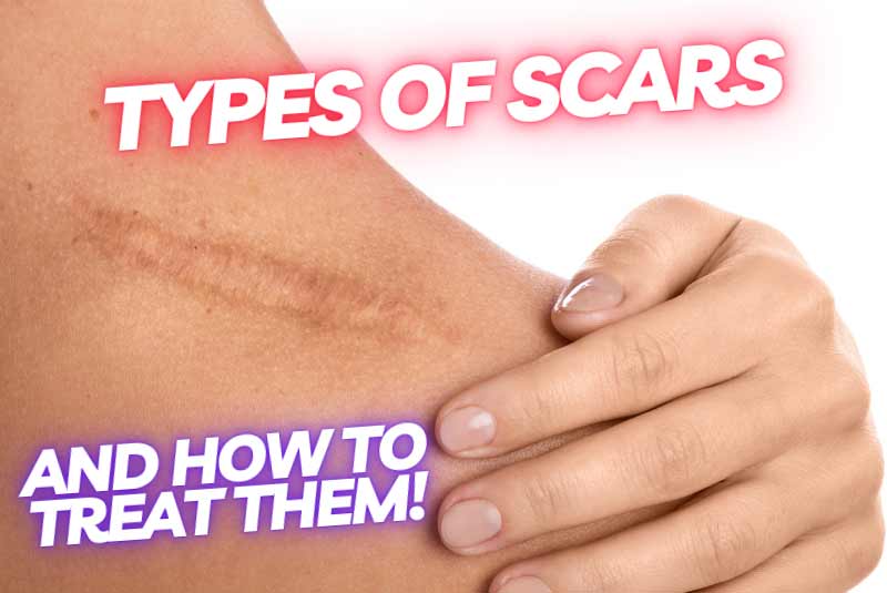 Scar treatment guide with microchanneling and thermolysis