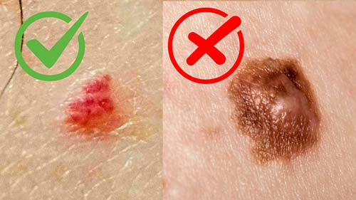 Melanoma are not cherry angiomas - skin classic can't treat them