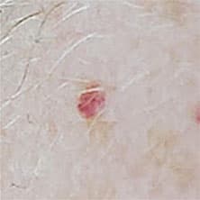 Cherry angioma treatment with thermolysis in Windsor