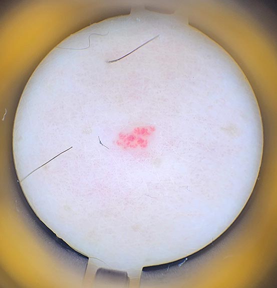 Cherry angioma seen through a profressional dermlite at Hideaway Spa