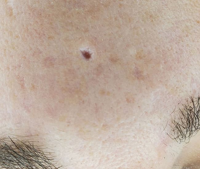 Pitted scar treatment demonstration Windsor