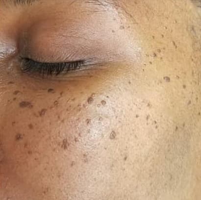 DPN (Dermatosis Papulosa Nigra) treatment in Windsor