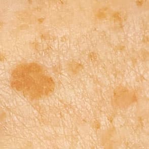 Lentigines and hyperpigmentation treatment Windsor