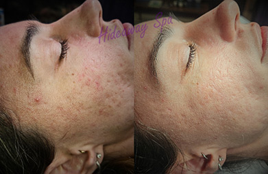 Acne scar improvement after Procell Microchanneling at Hideaway Spa
      Windsor — client before and after