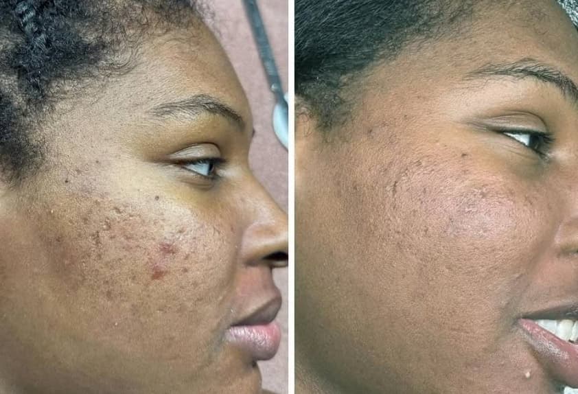 Before and after microchanneling microneedling: texture improvement