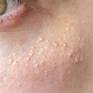 Milia extraction and treatment Windsor