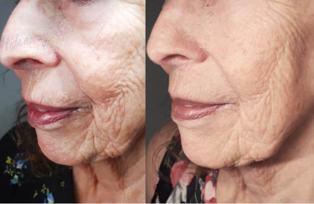 Procell microchanneling treatment on cheek for wrinkle reduction and collagen boost – Windsor