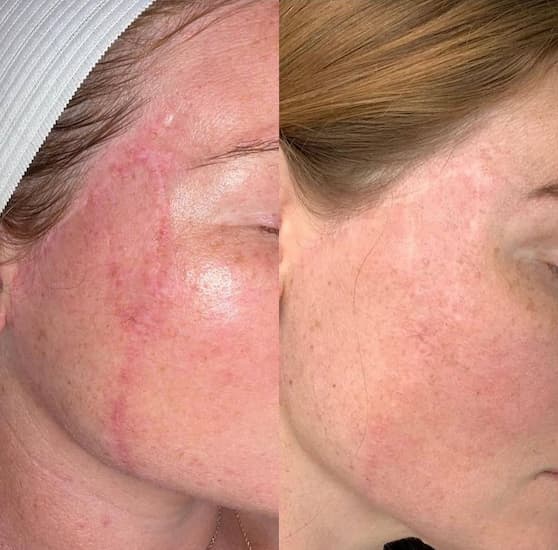 Before and after microchanneling microneedling: scar improvement Windsor