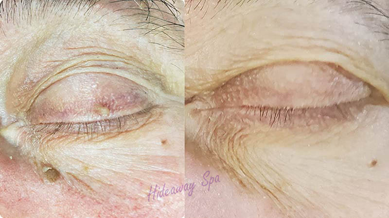 Before and after skin tag and seborrheic keratosis correction around the eye – Blemish Correction at Hideaway Spa Windsor