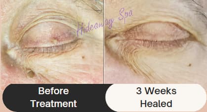 Before and after: skin tag and keratosis treatment on eyelid Windsor