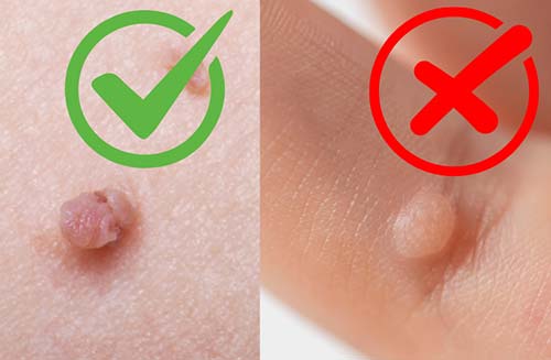 Warts are not skin tags - skin classic can't treat them